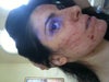 24 hours post Ng:Yag for brown spots