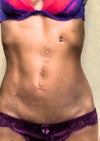 Scars on abdomen with no belly button and a feeding tube scar by ribs