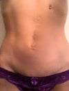 Scars on abdomen with no belly button and a feeding tube scar by ribs