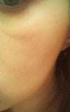 I'm often told that I look "tired" or that i've been "punched in the eye" because of the puffy appearance.