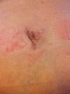 9 mos post op belly button