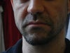 Now, a few months after being injected some hyaluronic acid. You can see the malar dent and its shadow.