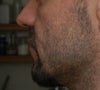 Looking at my profile you can see this hollow part under the "artificial" cheekbone and the sagging of the cheek.