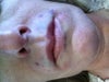 just after injections