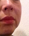 Left cheek remains swollen after 36 hours