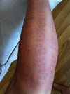 One hour after treatment.