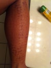 One day after treatment.