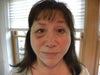 Four days after surgery. Here I am raising both eyebrows, but no upward movement on the right.
