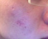 The burn is on the cheek. There is also some ice pick scars
