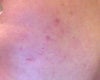 more hyper-pigmentation