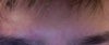 Another above the left brow