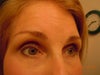 Doll's eye condition. Deep set eyes.