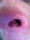 This was taken approx 2 weeks ago but incision has opened more since and still sore