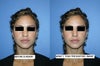The left side is my nose BEFORE surgery. 

The right side is what the doctor and I agreed it would look like.****computer imaging*****