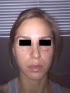 After Surgery