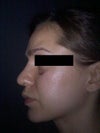 Side View after surgery