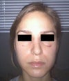 After Surgery