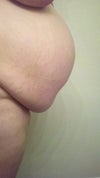 Severe Diastasis Recti