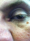 reddish bump in corner of eye