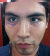 fat injection zone and dark circles under eyes