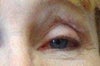 left eye with scars and lumps on upper lid after fat transer May 2011