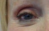 left eye before fat transfer May 2011