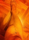 The growth on my leg
