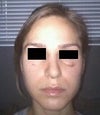 After Surgery