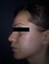Side view after surgery