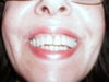my left side.. but your right in  the picture, you can see the arch about quarter inch higher in perosn, on this photo doesn't look as bad though