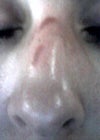 Scapes on nose