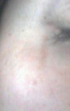 scrape below eye