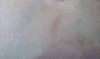 scrape above lip