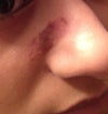 Day 3. Small raised bump near the top of the pigmented area is what I was initially trying to remove.