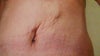 9 Weeks post-op