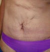 9 Weeks post-op