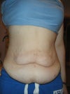 this is what i have been left with, i can feel my hips through the excess skin