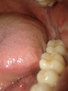 Left part on day 5 after wisdom teeth removal