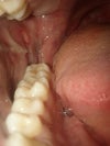 Right part on day 5 after wisdom teeth removal