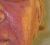blotchy skin 6 days post laser resurfacing