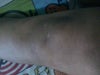 my scars