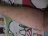 scars