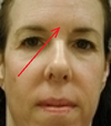 forehead
