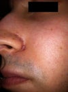 Scars from Yag laser: 3 weeks post-op