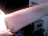 Loose skin on thighs