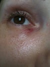 here you can see the purpura and all around redness an vessels broken