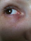after 1 week,you can see the purpura is gone but he let me a little hole