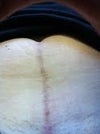 Vertical 7" scar beneath naval