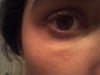 this eye has the dark pigmentation, I think the bump to the left is an actual blemish