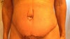 This is me after surgery